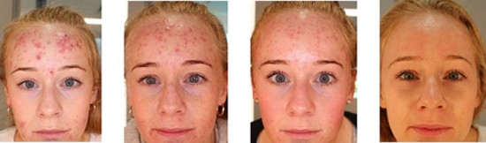 4163 - טיפול באקנה באמצעות -"רפואה ירוקה"   ריפוי טיבעי של עור הפנים.